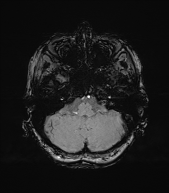 Anaplastic astrocytoma (Radiopaedia 86943-103160 Axial SWI 21).png
