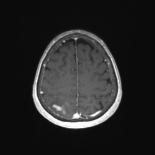 File:Anaplastic astrocytoma (Radiopaedia 86943-103160 Axial T1 C+ 67).png
