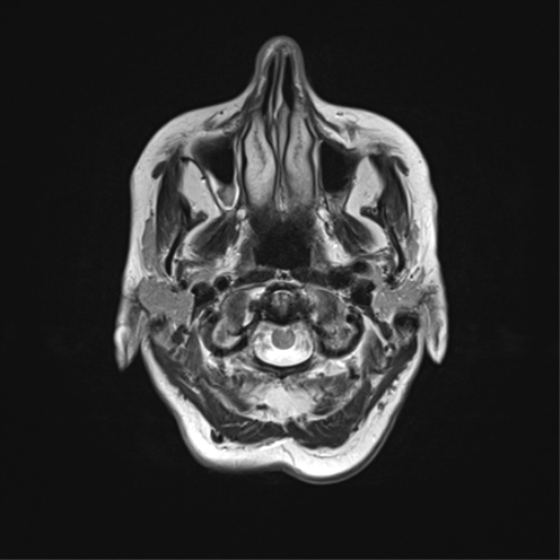 File:Anaplastic astrocytoma (Radiopaedia 86943-103160 Axial T2 4).png