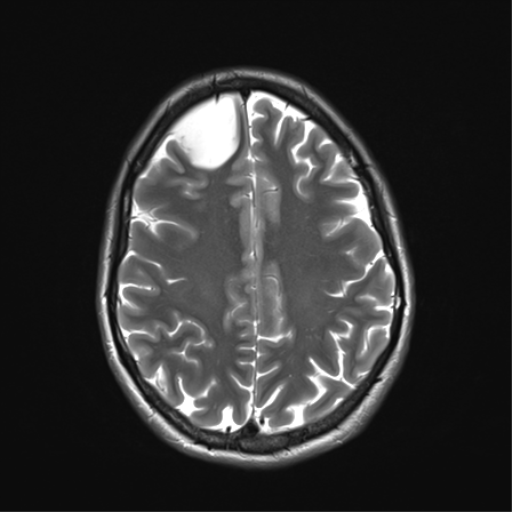 File:Anaplastic astrocytoma IDH mutant (Radiopaedia 50046-55341 Axial T2 28).png