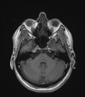 Anaplastic astrocytoma IDH wild-type (Radiopaedia 49984-55273 Axial T1 16).png