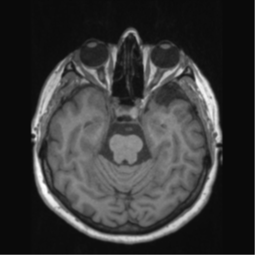Anaplastic astrocytoma IDH wild-type (pseudoprogression) (Radiopaedia 42209-45276 Axial T1 58).png