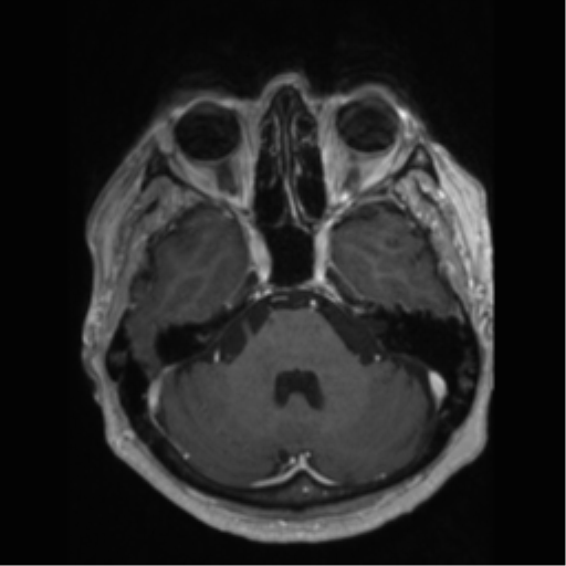 File:Anaplastic astrocytoma IDH wild-type (pseudoprogression) (Radiopaedia 42209-45277 Axial T1 C+ 32).png