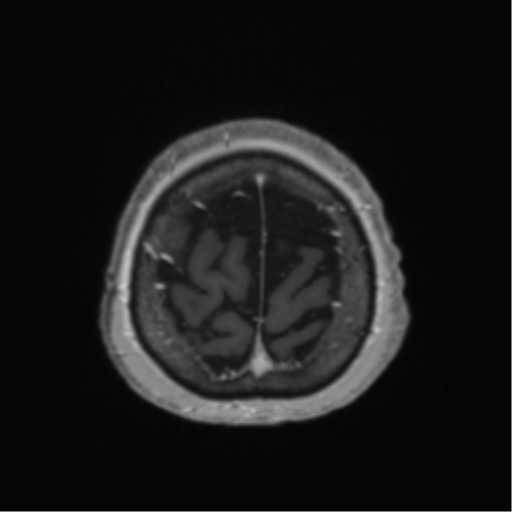 Anaplastic astrocytoma IDH wild-type (pseudoprogression) (Radiopaedia 42209-45278 Axial T1 C+ 136).png