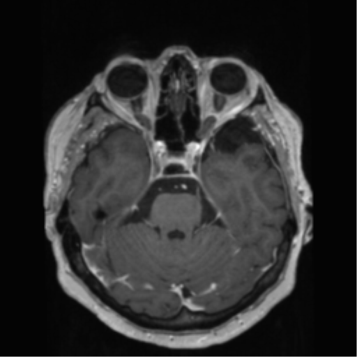File:Anaplastic astrocytoma IDH wild-type (pseudoprogression) (Radiopaedia 42209-45278 Axial T1 C+ 58).png