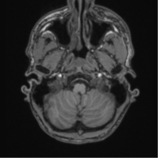 Anaplastic oligodendroglioma with skull fracture (Radiopaedia 74831-85845 Axial T1 4).png