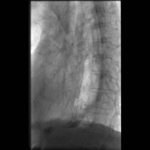 File:Anastomotic stricture post Ivor Lewis esophagectomy (Radiopaedia 47937-52715 E 1).png