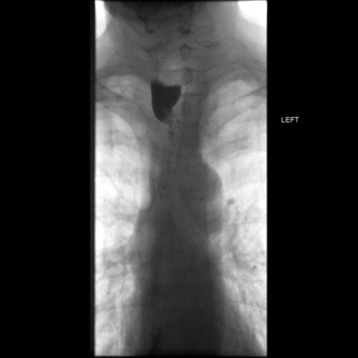 File:Anastomotic stricture post Ivor Lewis esophagectomy (Radiopaedia 47937-52715 Frontal 22).png