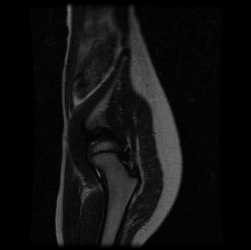 File:Aneurysmal bone cyst - sacrum (Radiopaedia 65190-74196 Sagittal T2 3).jpg