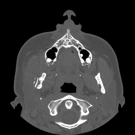 File:Aneurysmal bone cyst of the mandible (Radiopaedia 43280-46823 Axial bone window 97).jpg