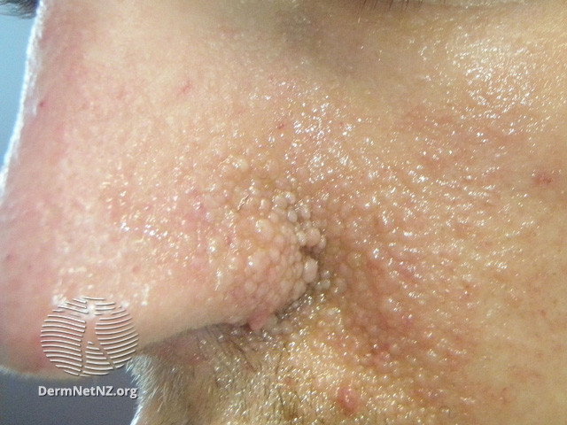 File:Angiofibromas in tuberous sclerosis (DermNet NZ systemic-tuberous-sclerosis09).jpg
