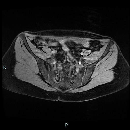 File:Angioleiomyoma (Radiopaedia 85442-101078 Axial T1 3D fat sat 3).jpg