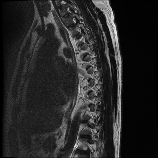 File:Angiolipoma - thoracic spine (Radiopaedia 28242-28479 Sagittal T2 3).jpg