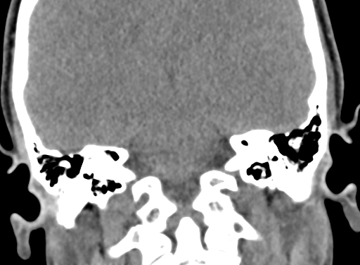 Angular dermoid cyst (Radiopaedia 88967-105790 Coronal non-contrast 79).jpg