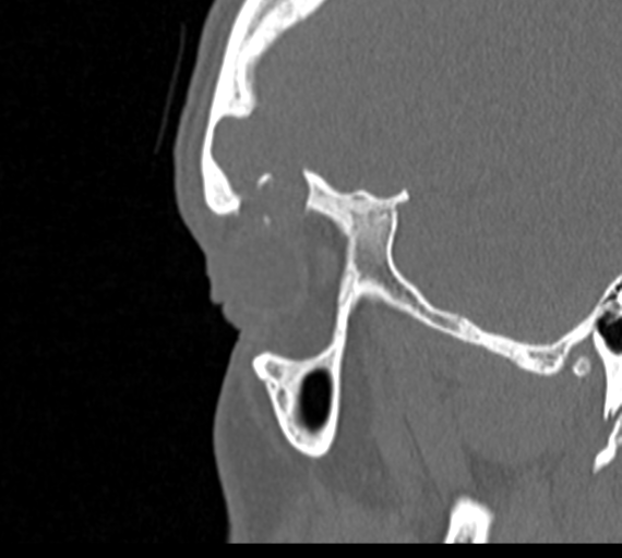 Angular epidermoid cyst (Radiopaedia 46908-51439 Sagittal bone window 82).png