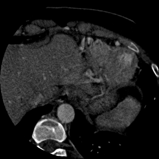 Anomalous left coronary artery from the pulmonary artery (ALCAPA) (Radiopaedia 40884-43586 A 80).jpg