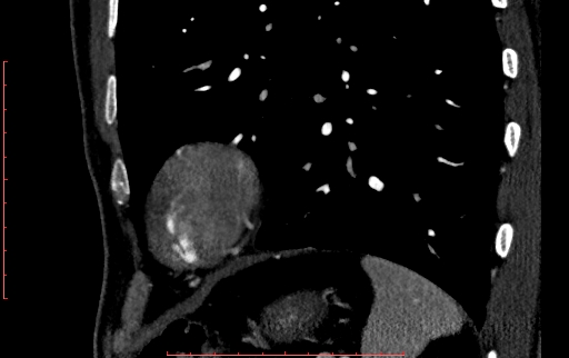 File:Anomalous left coronary artery from the pulmonary artery (ALCAPA) (Radiopaedia 70148-80181 C 247).jpg