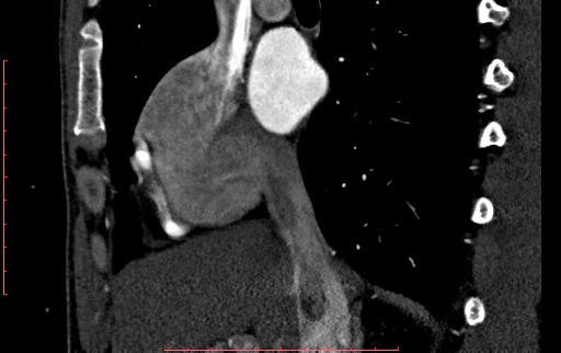 File:Anomalous left coronary artery from the pulmonary artery (ALCAPA) (Radiopaedia 70148-80181 C 42).jpg