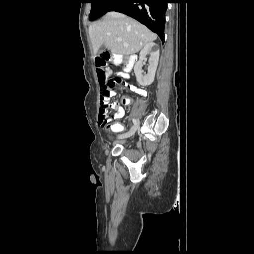 Anorectal carcinoma (Radiopaedia 44413-48064 C 31).jpg
