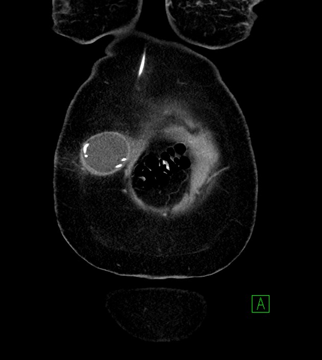 Anterior abdominal wall CSF pseudocyst (CSFoma) (Radiopaedia 79453-92571 B 11).jpg