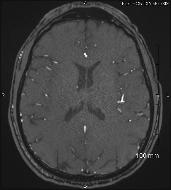 Anterior cerebral artery aneurysm (Radiopaedia 80683-94127 Axial MRA 149).jpg