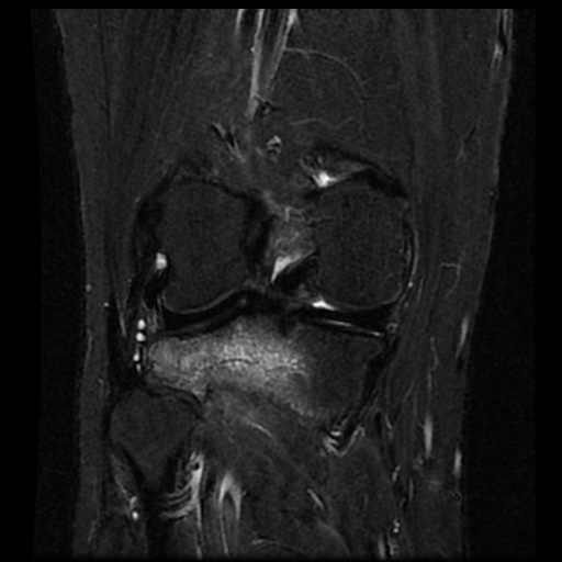 File:Anterior cruciate ligament avulsion fracture (Radiopaedia 58939-66193 Coronal STIR 13).jpg