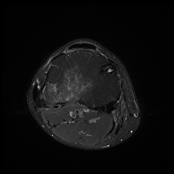 File:Anterior cruciate ligament graft tear and bucket-handle tear of medial meniscus (Radiopaedia 75867-87254 Axial PD fat sat 5).jpg