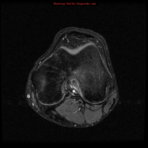 File:Anterior cruciate ligament injury - partial thickness tear (Radiopaedia 12176-12515 Axial PD 13).jpg