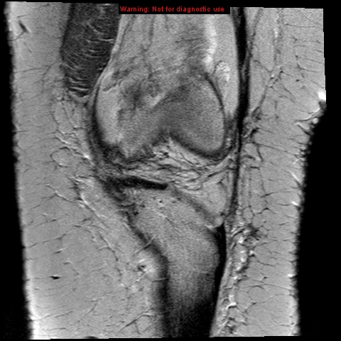 File:Anterior cruciate ligament tear (Radiopaedia 12329-12612 Coronal PD 3).jpg
