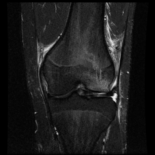 File:Anterior cruciate ligament tear (Radiopaedia 61500-69462 Coronal STIR 11).jpg