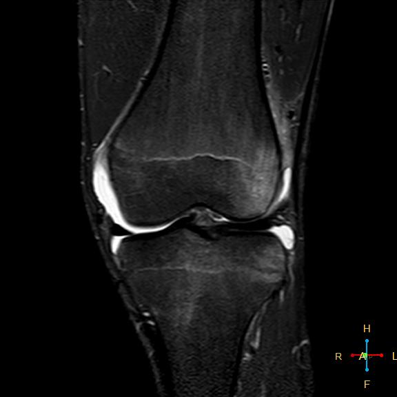 File:Anterior cruciate ligament tear - complete (Radiopaedia 24907-25170 Coronal STIR 9).jpg