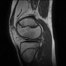 Anterior cruciate ligament tear - pediatric (Radiopaedia 62152-70260 Sagittal PD 127).jpg