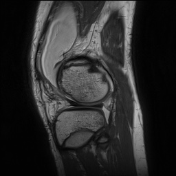 Anterior cruciate ligament tear - pediatric (Radiopaedia 62152-70260 Sagittal PD 138).jpg