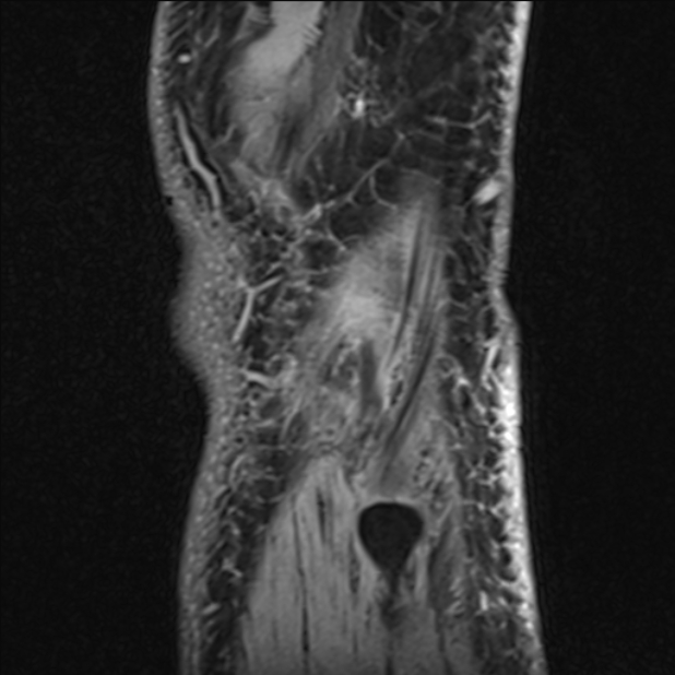 Anterior cruciate ligament tear - ramp lesion (Radiopaedia 71883-82322 Sagittal T1 vibe 13).jpg