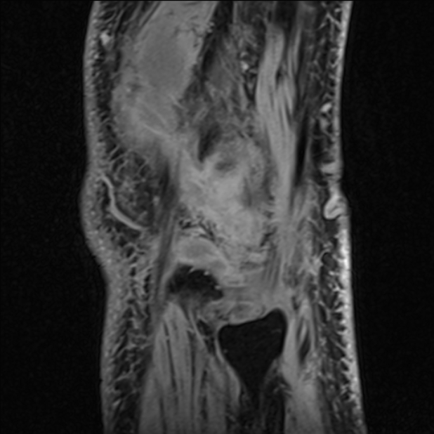 Anterior cruciate ligament tear - ramp lesion (Radiopaedia 71883-82322 Sagittal T1 vibe 19).jpg