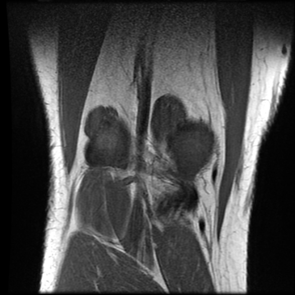 File:Anterior cruciate ligament tear with posteromedial corner injury, bucket-handle meniscal tear and chondral delamination (Radiopaedia 75501-86744 Coronal T1 22).jpg