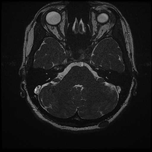 Anterior inferior cerebellar artery vascular loop - type II (Radiopaedia 70991-81209 Axial 3D FIESTA 30).jpg