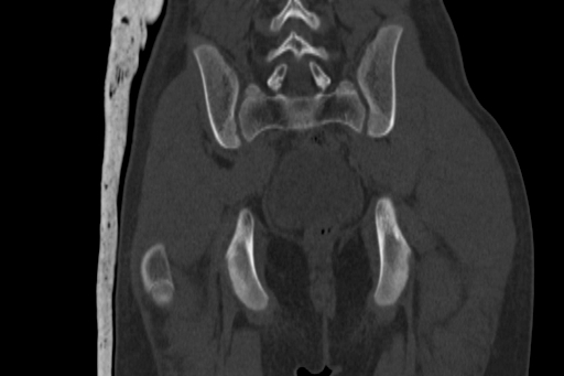 Anterior inferior iliac spine avulsion injury (Radiopaedia 88666-105376 Coronal bone window 52).jpg