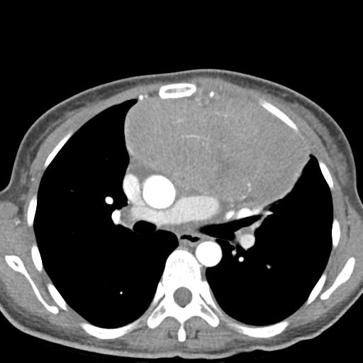 File:Anterior mediastinal lymphoma (Radiopaedia 29556-30061 C 24).jpg