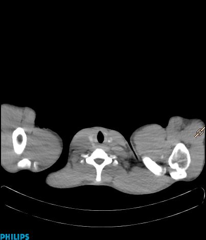 File:Anterior mediastinal seminoma (Radiopaedia 80270-93613 C 7).jpg