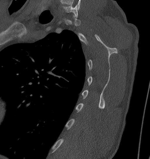 Anterior shoulder dislocation with Hill-Sachs and bony Bankart lesions (Radiopaedia 40424-42974 Sagittal bone window 50).png