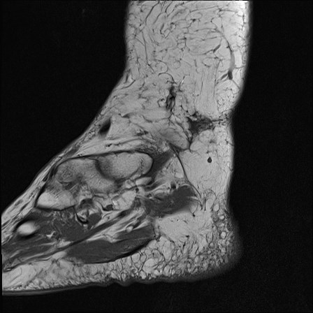 File:Anterior talofibular ligament injury - rupture with soft-tissue impingement (Radiopaedia 38765-40928 Sagittal PD 1).jpg
