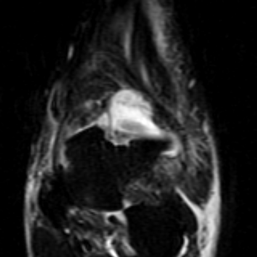 File:Anterior talofibular ligament rupture (Radiopaedia 15831-15484 Coronal STIR 6).jpg