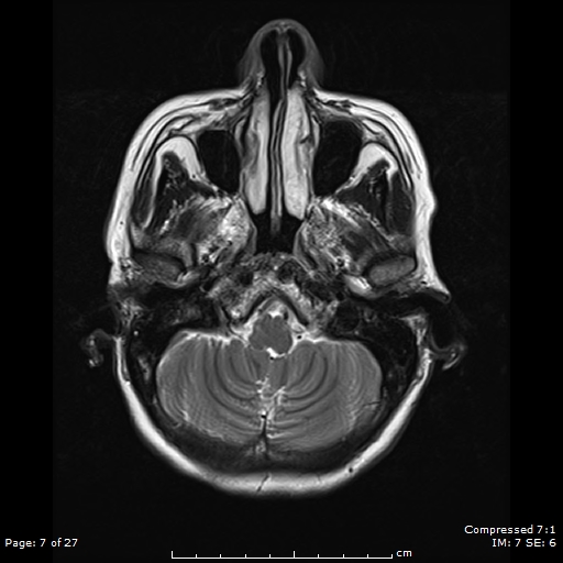 File:Anterior temporal lobe perivascular space (Radiopaedia 88283-104914 Axial T2 7).jpg