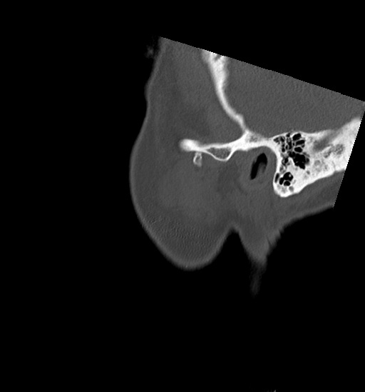 Anterior temporomandibular joint dislocation (Radiopaedia 59430-66784 B 61).jpg