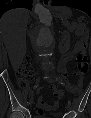 File:Anterior vertebral scalloping (abdominal aortic aneurysm) (Radiopaedia 66744-76067 Coronal bone window 21).jpg