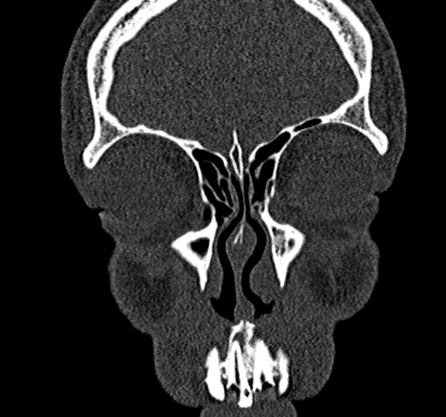 Antrochoanal polyp (Radiopaedia 30002-30554 Coronal bone window 21).jpg