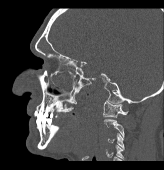 Antrochoanal polyp (Radiopaedia 79011-92169 Sagittal bone window 47).jpg