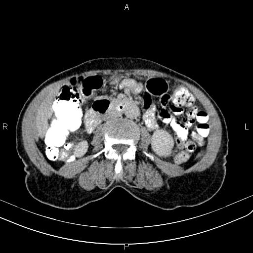 Aortic aneurysm and Lemmel syndrome (Radiopaedia 86499-102554 Axial C+ delayed 40).jpg
