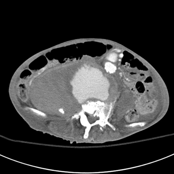 File:Aortic aneurysm with spinal destruction (Radiopaedia 42301-45410 A 62).jpg